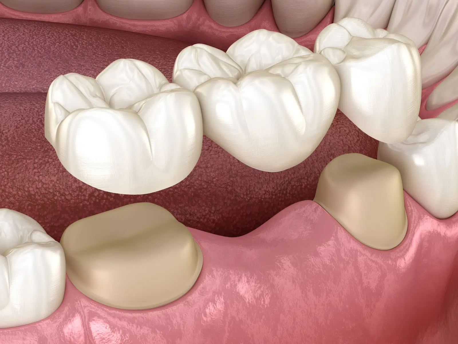 Cosmetic-Dentistry-Procedures-3-How-Do-Dental-Bridges-Work.jpg