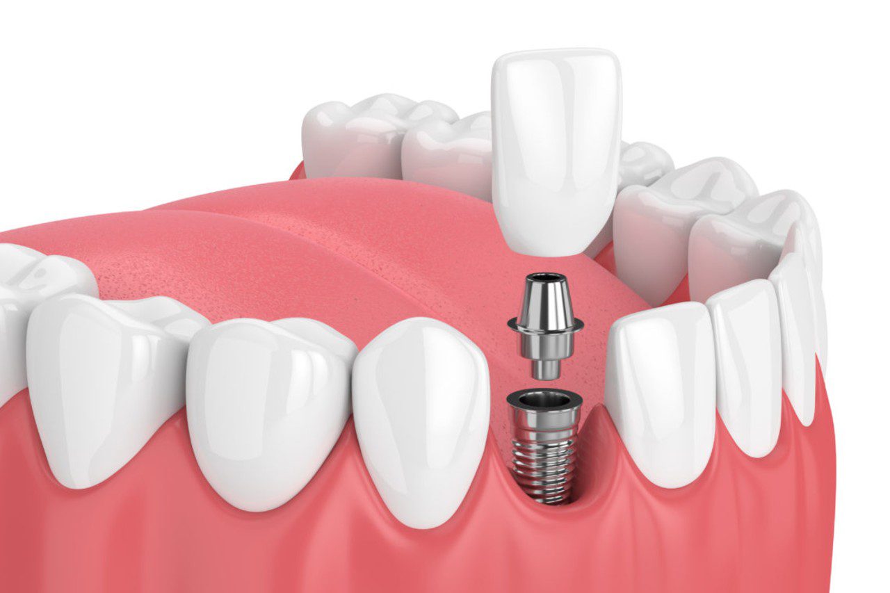 Dental-Implants-Near-Me-Wollongong-Ambience-Dental