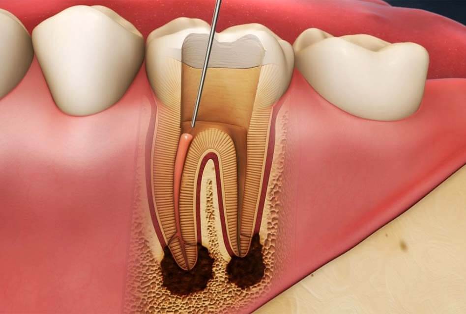 Root-Canal-1