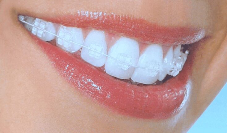 clear-braces-barrhaven-orthondontist-braces-haven clear-braces-barrhaven-orthondontist-braces-haven