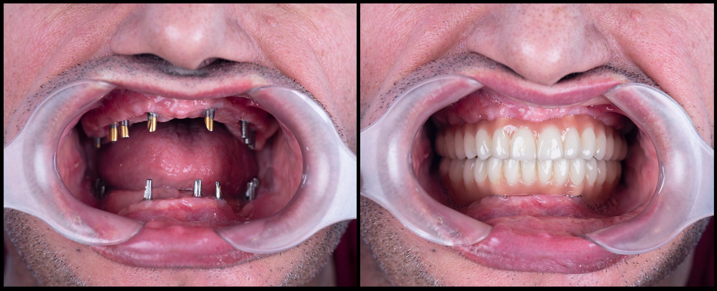 full mought re construction by dental implants and ceramic crown